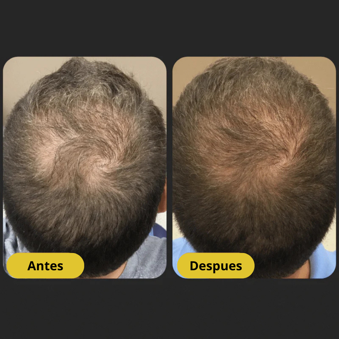 Surogatu™ - Shampoo Activador de Raíces para Hombres contra la Pérdida de Cabello – Mayor crecimiento con solo 4 lavados a la semana