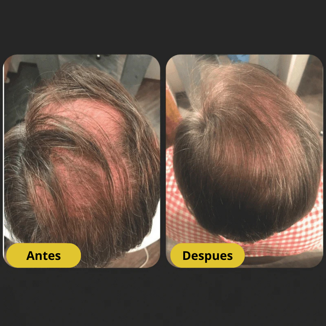 Surogatu™ - Shampoo Activador de Raíces para Hombres contra la Pérdida de Cabello – Mayor crecimiento con solo 4 lavados a la semana