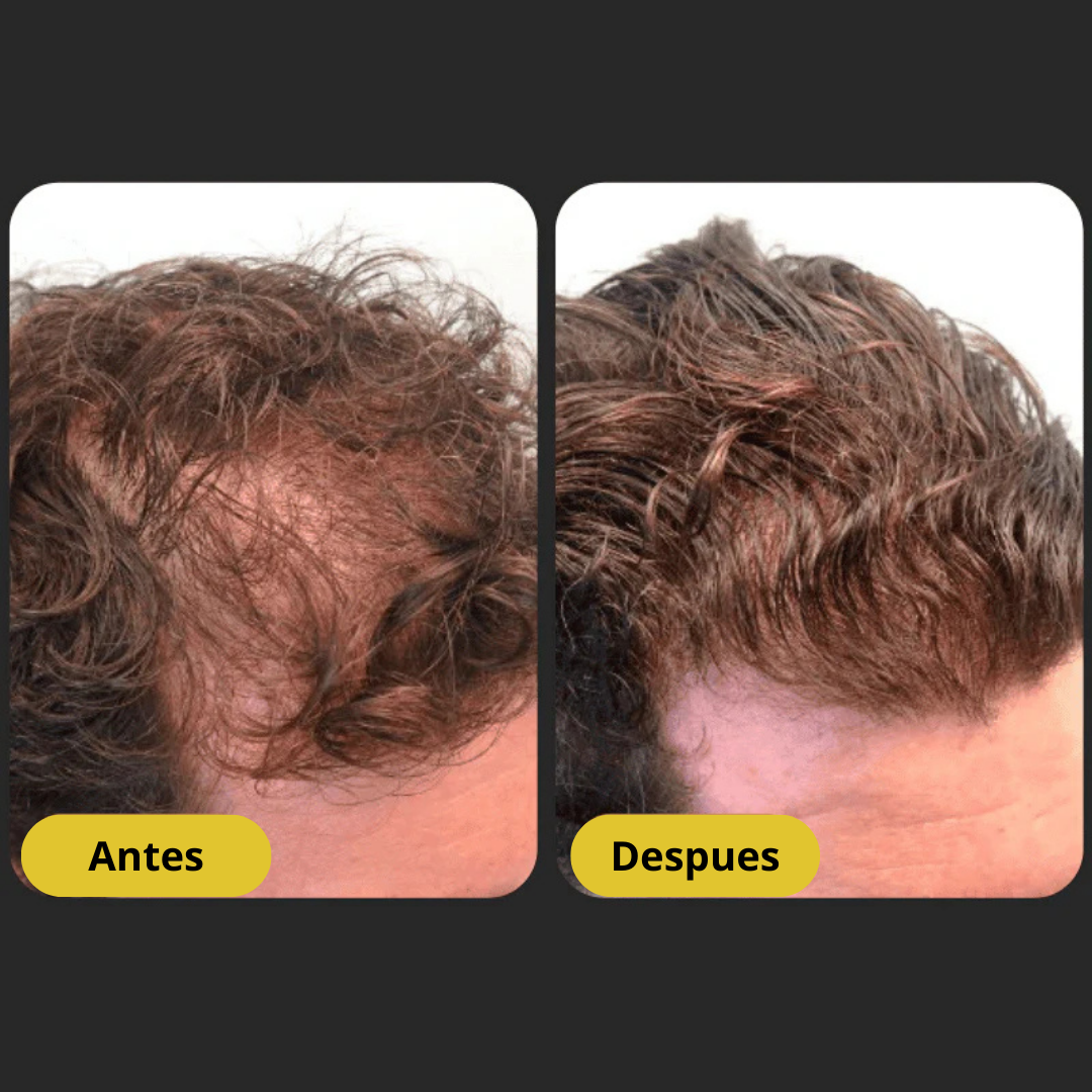 Surogatu™ -  Shampoo Activador de Raíces para Hombres contra la Pérdida de Cabello – Mayor crecimiento con solo 4 lavados a la semana